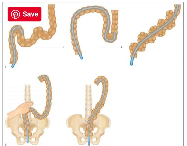 視個人的乙狀結腸的形狀，還有調教的熟練度與長肛塞的長度與順服度，乙狀結腸可以被撐成各種形狀。不過這張圖還是從大腸鏡的教學網頁上取下來的。圖片取自 https://www.rrnursingschool.biz/sigmoid-colon/ii.html