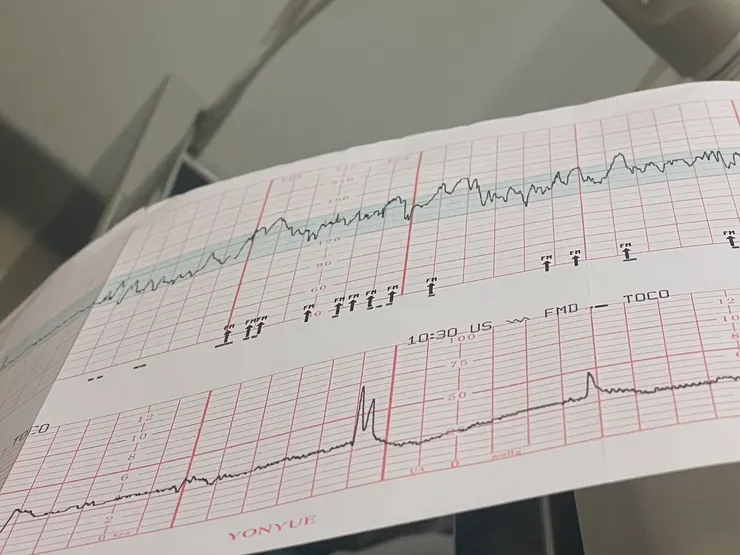 Ching拍攝/胎心音曲線圖