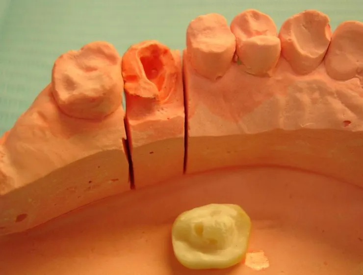 拔牙前的最後希望！牙齒的最後防線！渥爾牙醫用Cap-Lock技術守住天然牙！