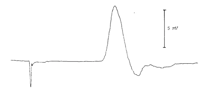 史上第一次TMS紀錄