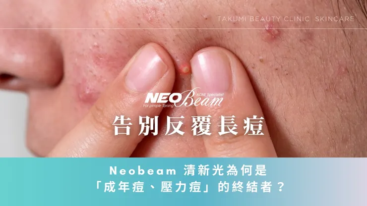 告別反覆長痘！Neobeam 清新光為何是「成年痘、壓力痘」的終結者？