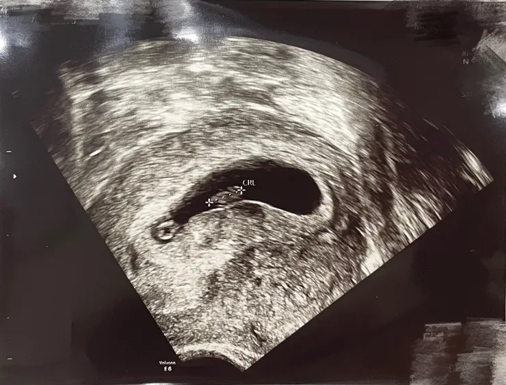 第六週胎兒超音波圖/Ching