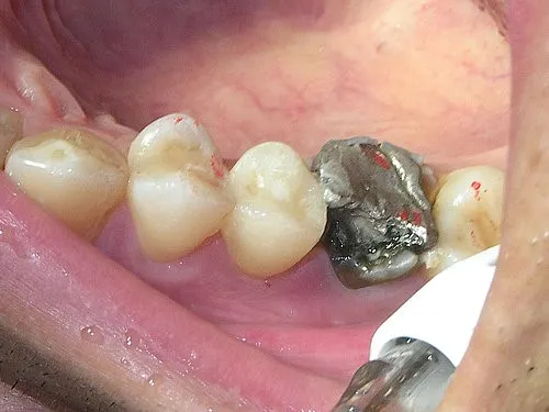 渥爾牙醫診所:斜裂小臼齒修復案例!Cap-Lock全瓷系列的完美應用(案例一)