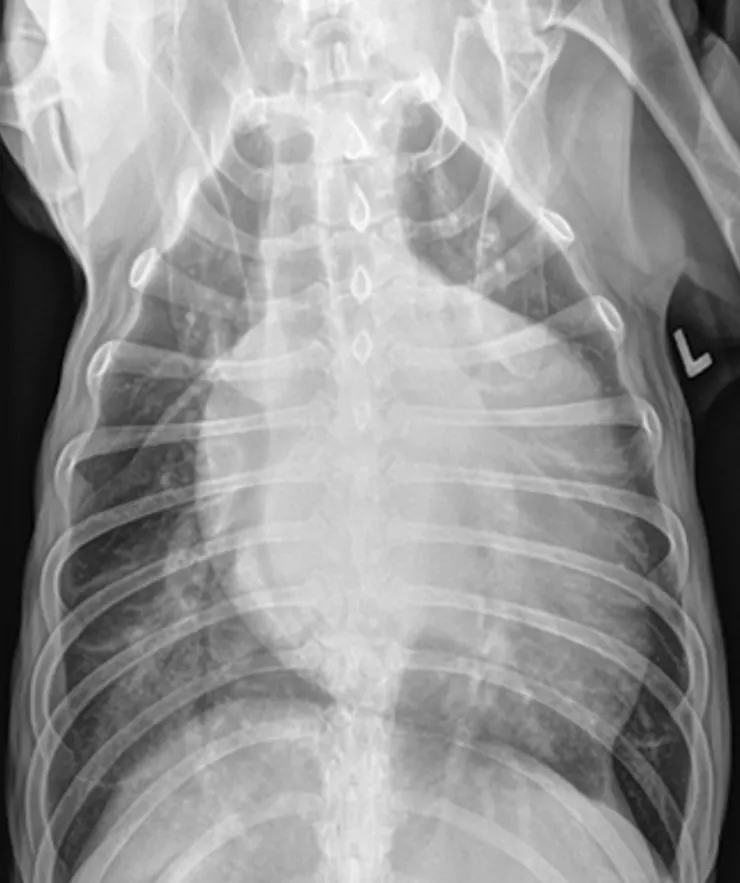 心臟擴張肺積水