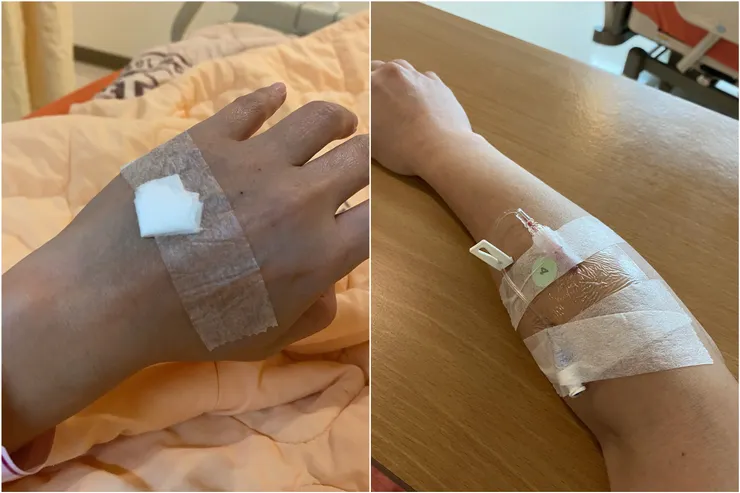 兩手都扎針已經是標配了