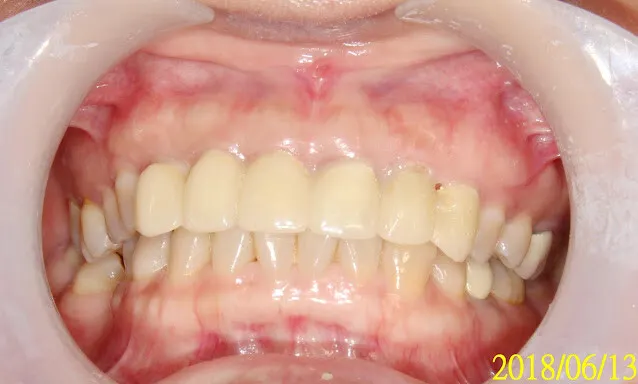 快結束了我才想到補拍她臨時牙套，2017剛拆舊牙套就已經做了