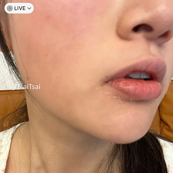 脂漏性皮膚炎脫皮症狀