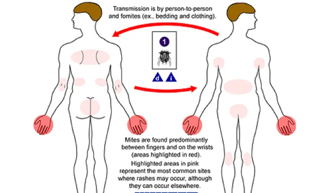疥瘡常見部位(資料來源:網路)