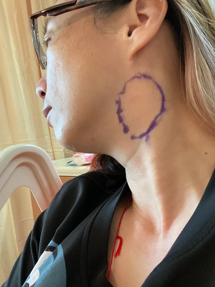 標記明天要開刀的地方