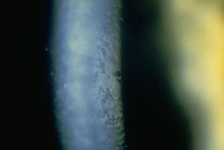 角膜點狀變性—AAO