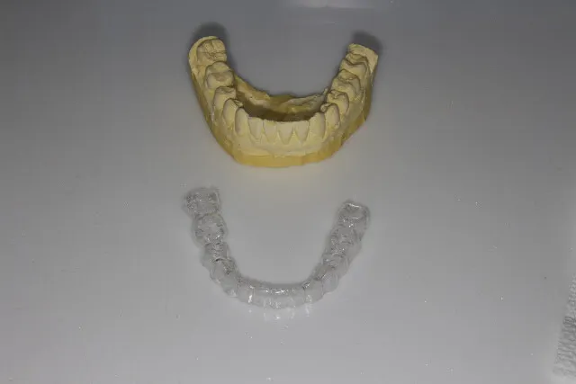 透明維持器（clear overlay）與石膏模型分離，跟隱形牙套很像吧，兩者工序很像，只是材質不同