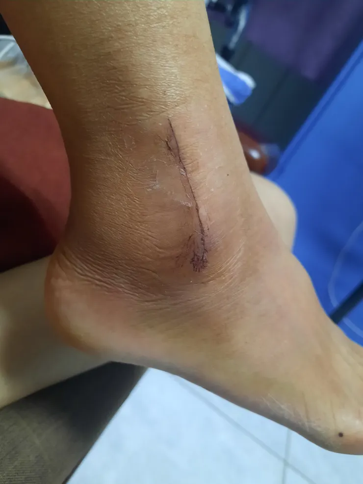 5／21換藥拍一下😵‍💫