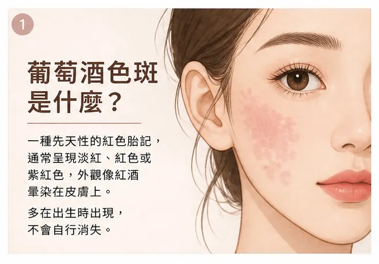 葡萄酒色斑是什麼