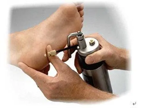 液態氮噴槍(資料來源:網路)