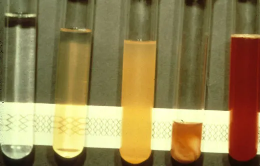 usmlepathslides:
“ Synovial fluid tubes:
From left to right,
•  normal
• noninflammatory (e.g., osteoarthritis)
• inflammatory (e.g., rheumatoid arthritis)
• septic (e.g., gonococcal septic arthritis)
•  hemorrhage (e.g., trauma, hemophilia A)
”