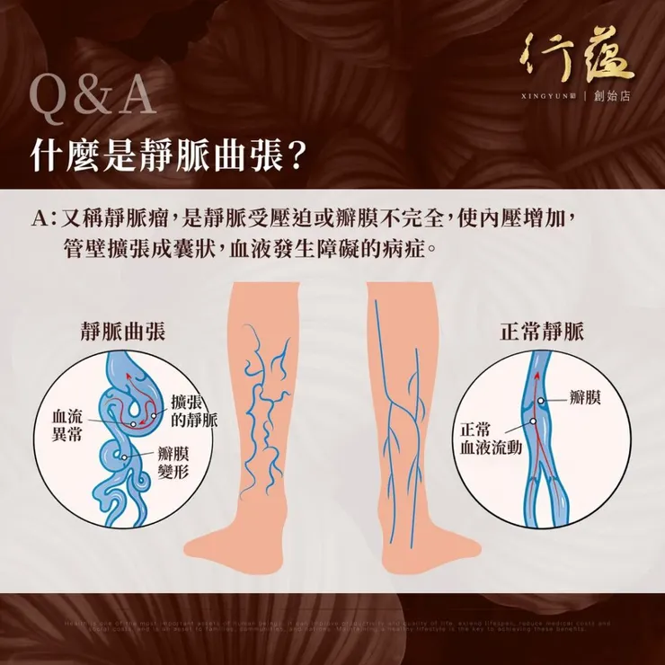 行蘊QA｜什麼是靜脈曲張