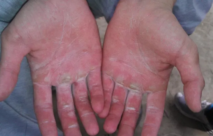 練到手都長繭跟破皮