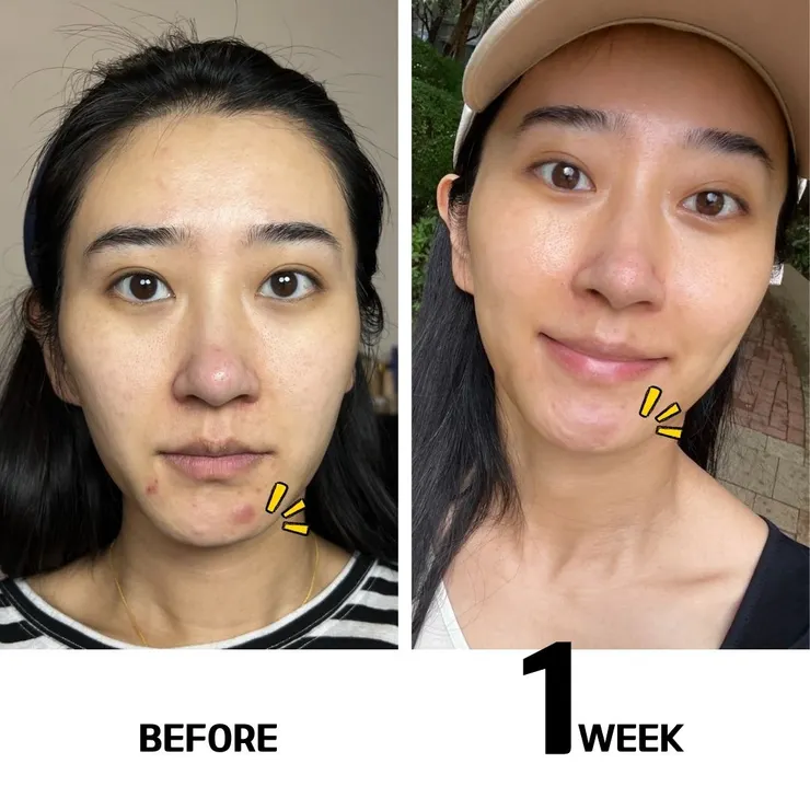 ATLA擦的淨膚-肌密能量水使用前後對比、評價