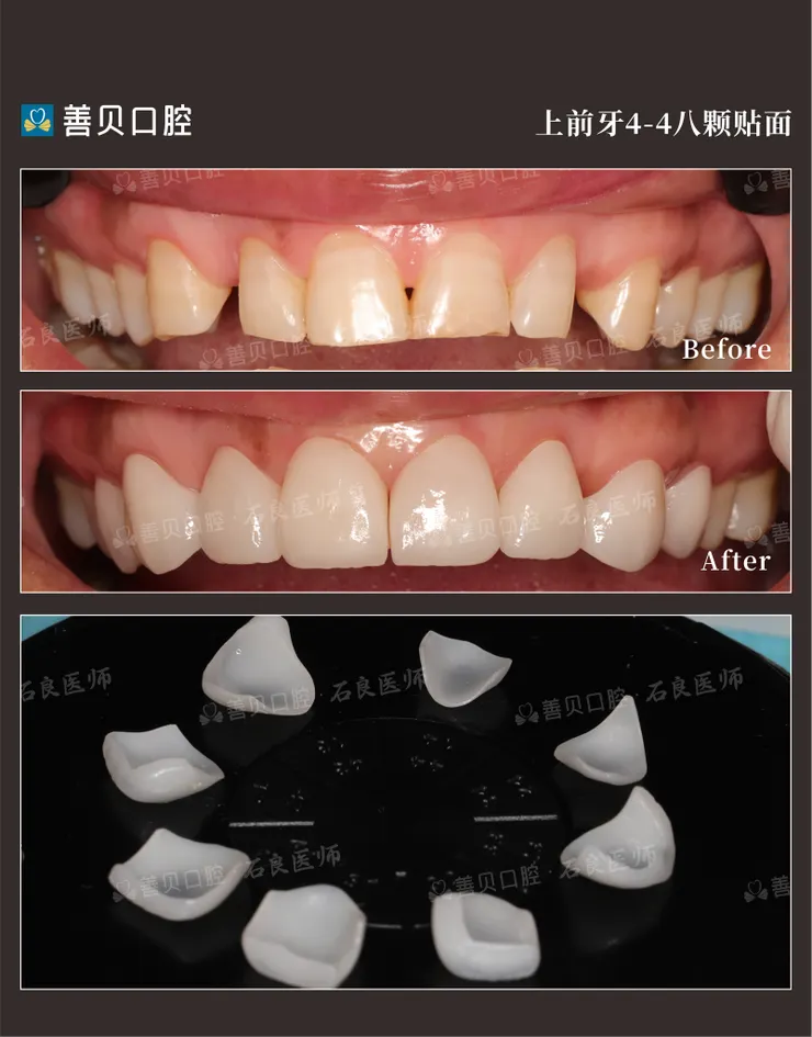 善貝口腔石良醫師-深圳牙齒貼面醫師