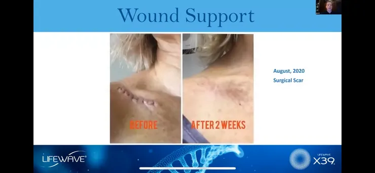 支持傷口復原：2020年08月 外科手術傷口癒合
