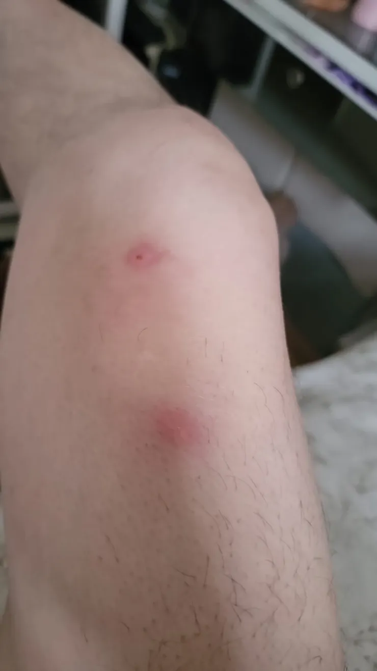 大腿後側床蝨咬痕，呈多顆發炎紅點腫起