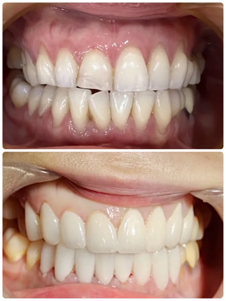 「明眸鋯齒」美白貼片，16顆齒列改造打造專屬你的自信微笑！