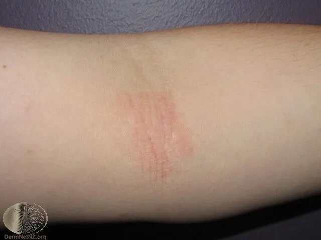 圖一：手肘紅色溼疹的樣子