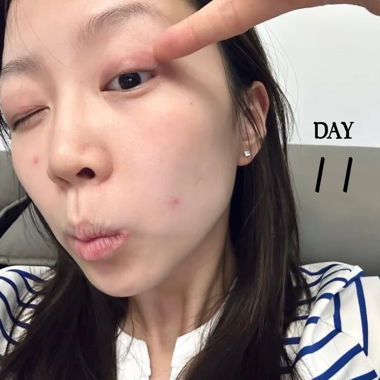 肌膚過敏前後對比