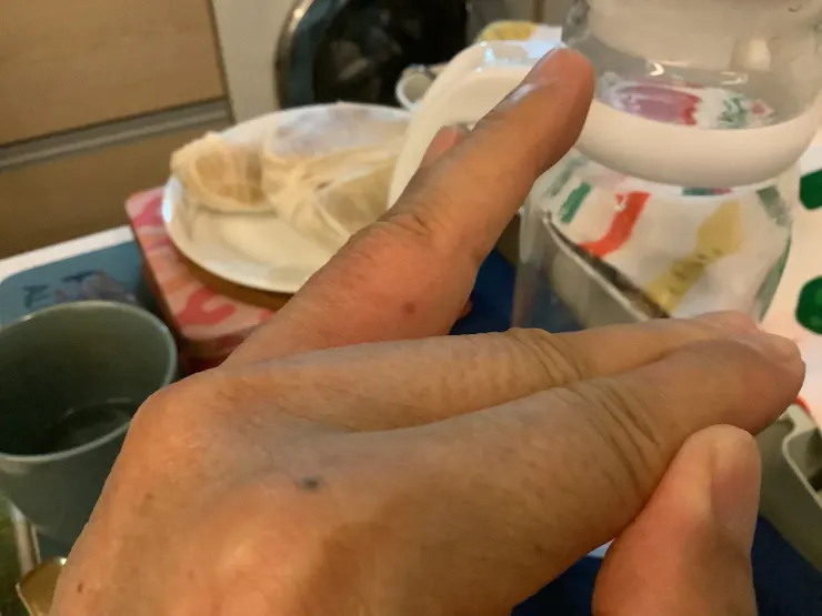 圖一：爺爺左手第四指內側被峰咬紅點位置