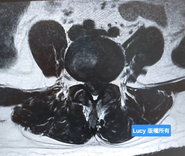 核磁共振影像看到第4、5節椎間盤嚴重破裂，已看不到白色脊髓