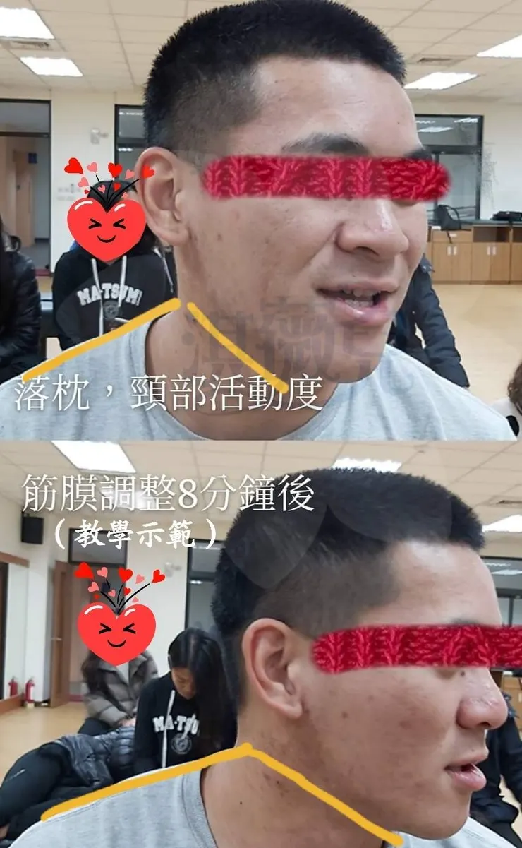 肌筋膜按摩   頸部活動度前後比較