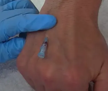 移除針頭，所以現在就只剩下細小導管安置在靜脈中了！