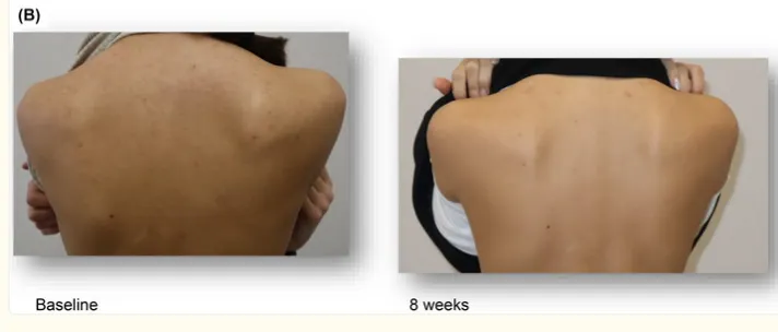 (其中一受試者，使用前vs使用後：背部痘痘顯著改善。擷取自該報告FIGURE 5 (B))
