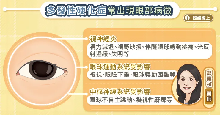 多發性硬化症常出現眼部病徵
