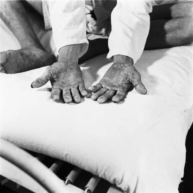 圖1 烏腳病患者手部特寫 案名：1953年農復會專輯 檔號：0041/0029/1 來源機關：行政院新聞局 管有機關：國家發展委員會檔案管理局