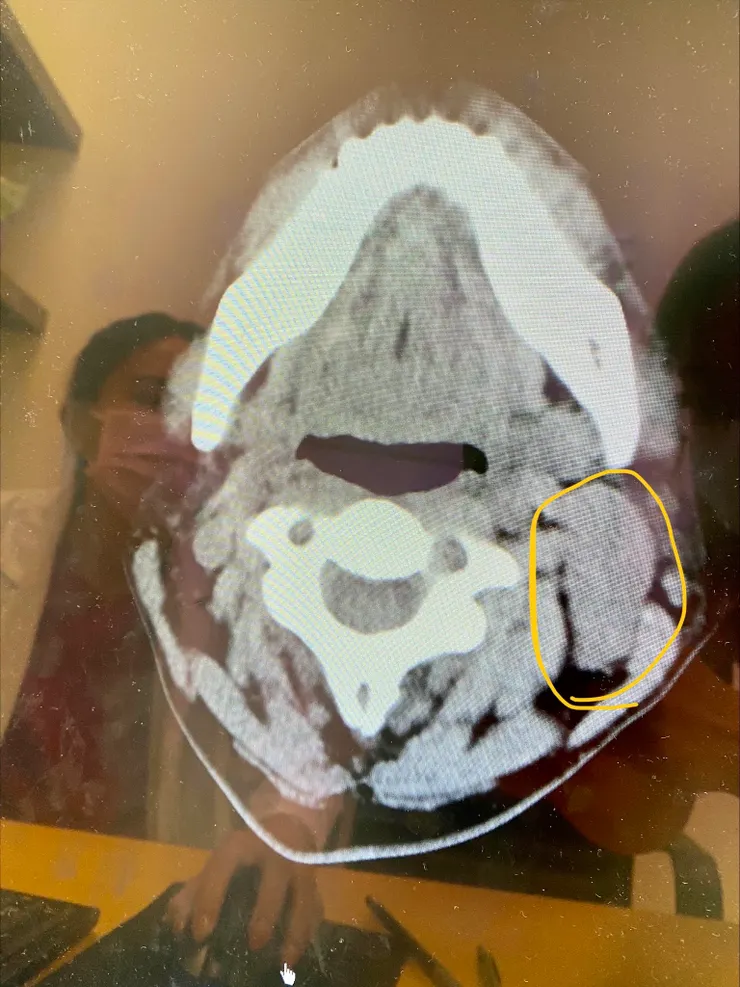 電腦斷層檢查 CT 可以清楚看到腫塊的位置和大小