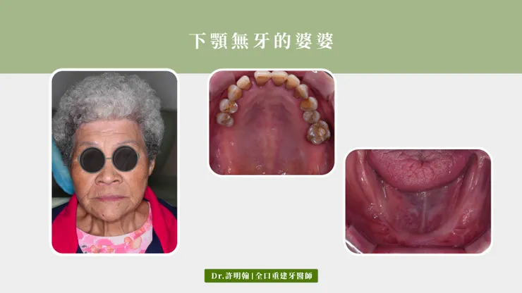 下顎無牙的婆婆