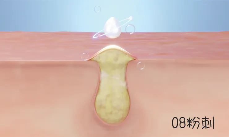 粉刺形成/除粉刺