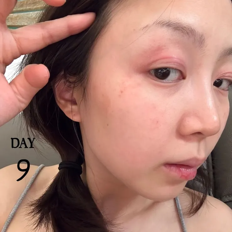 肌膚過敏前後對比