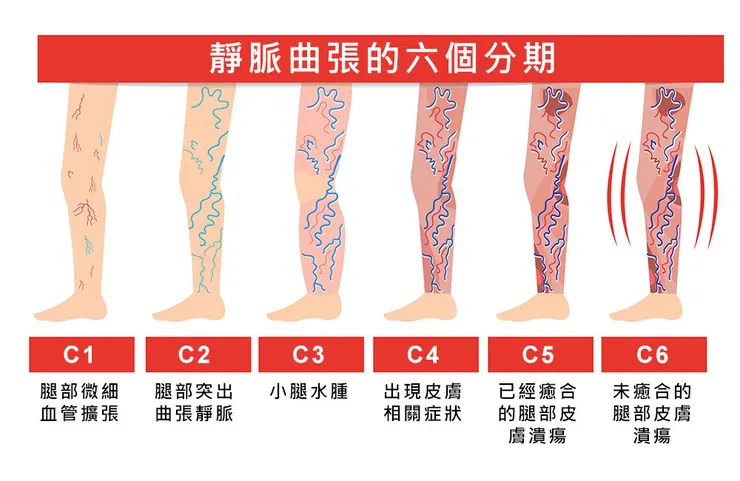 下肢靜脈曲張依照症狀可分為C1-C6分級