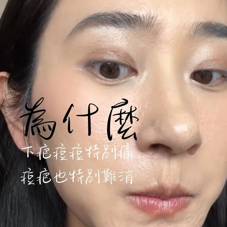 下疤痘痘特別痛，痘疤也特別難消