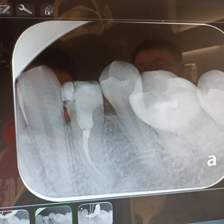 第一次治療兩年後的樣子