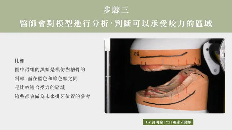 醫師會分析模型 判斷可以承受咬力的區域