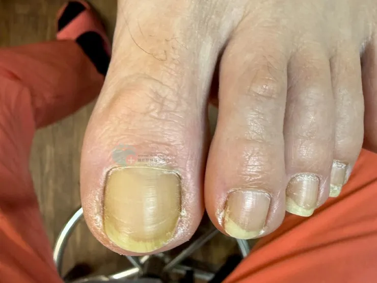 指甲插到肉 崁甲 台北板橋維妮問題指甲