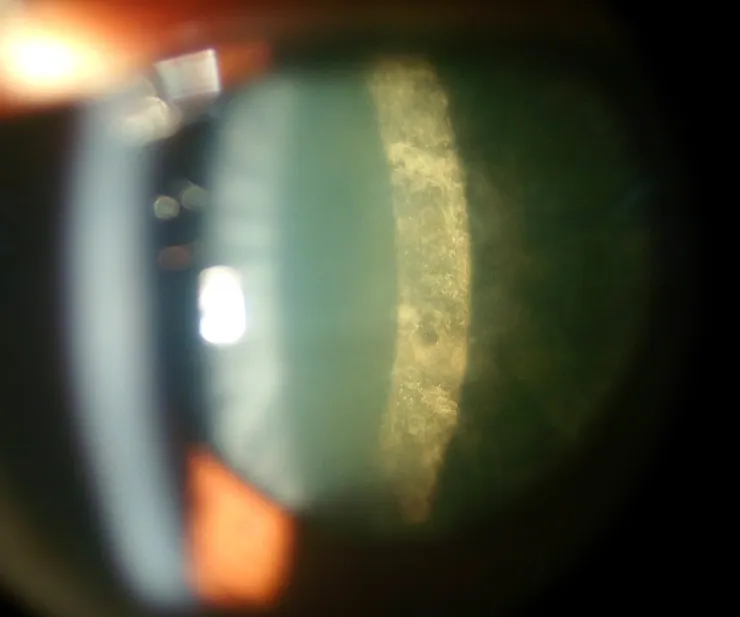Posterior Subcapsular Cataract-Wikipedia
