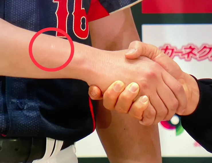 疑似Ace留下的咬痕