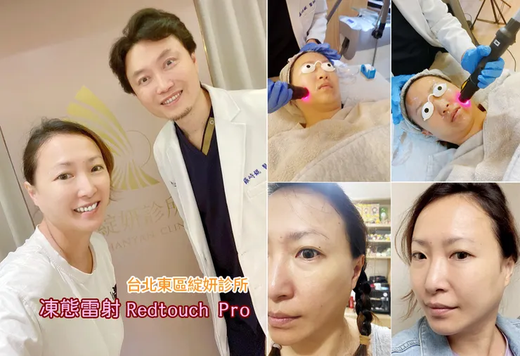 台北東區打雷射｜RedTouch PRO凍態雷射(果凍光)│台北打雷射推薦綻妍醫美診所