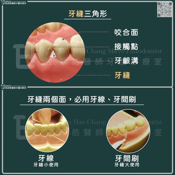 牙縫蛀牙，新竹顯微根管治療張添皓