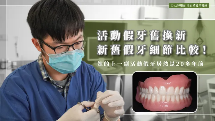 活動假牙舊換新 新舊活動假牙細節比較—許明翰醫師案例