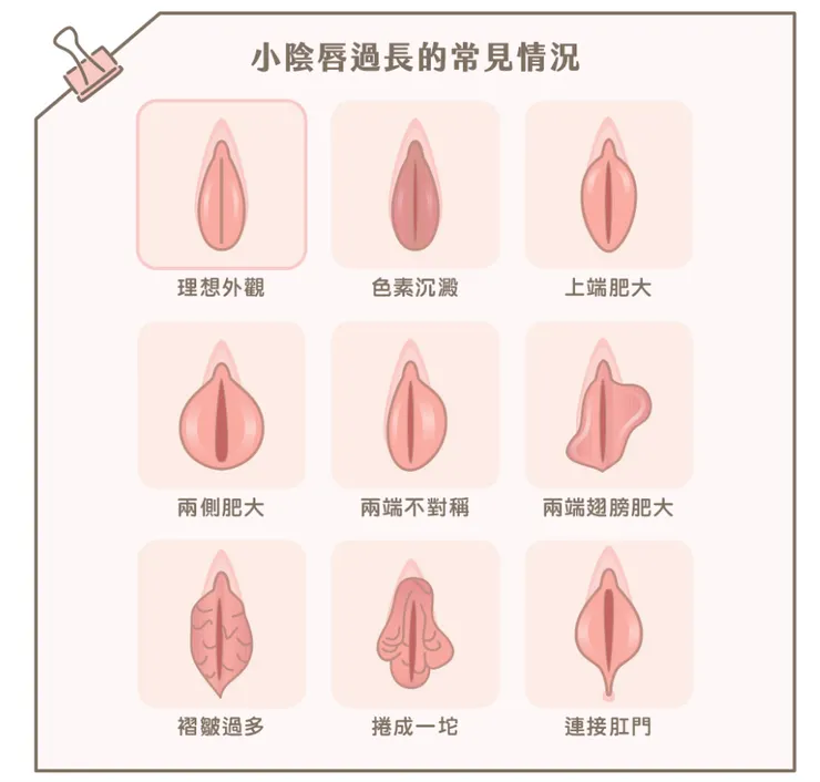 9種女生私密處的形狀圖，包括陰唇肥大、兩邊陰唇不對稱等。